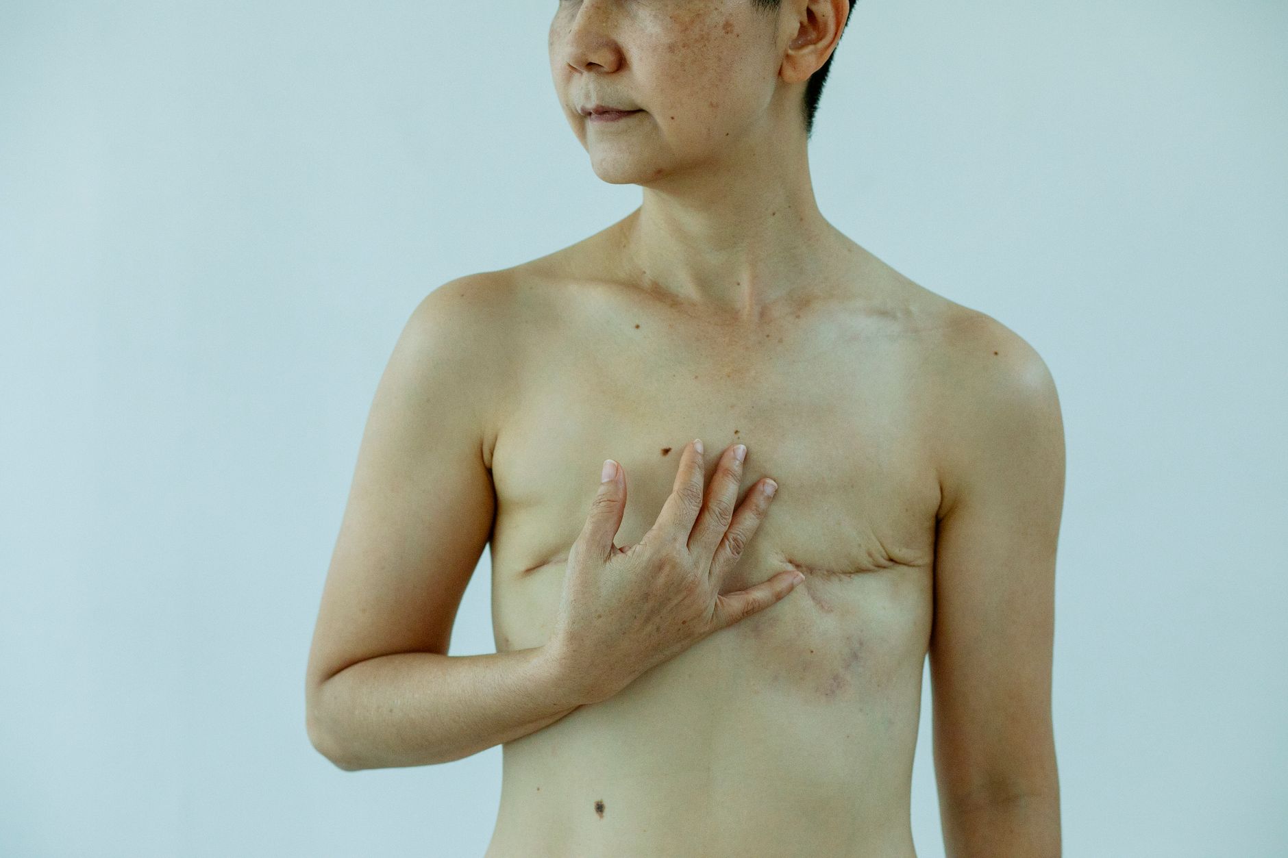 Mulher com a mão sobre a cicatriz de mastectomia