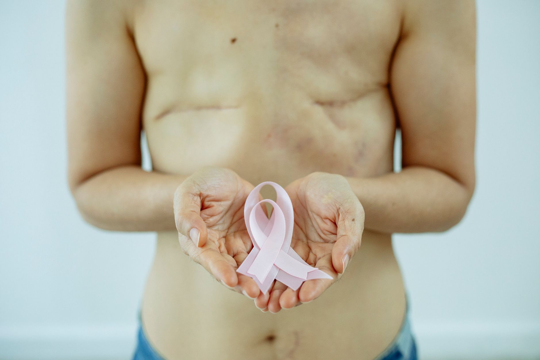 Mulher segurando laço rosa, com cicatriz de mastectomia visível