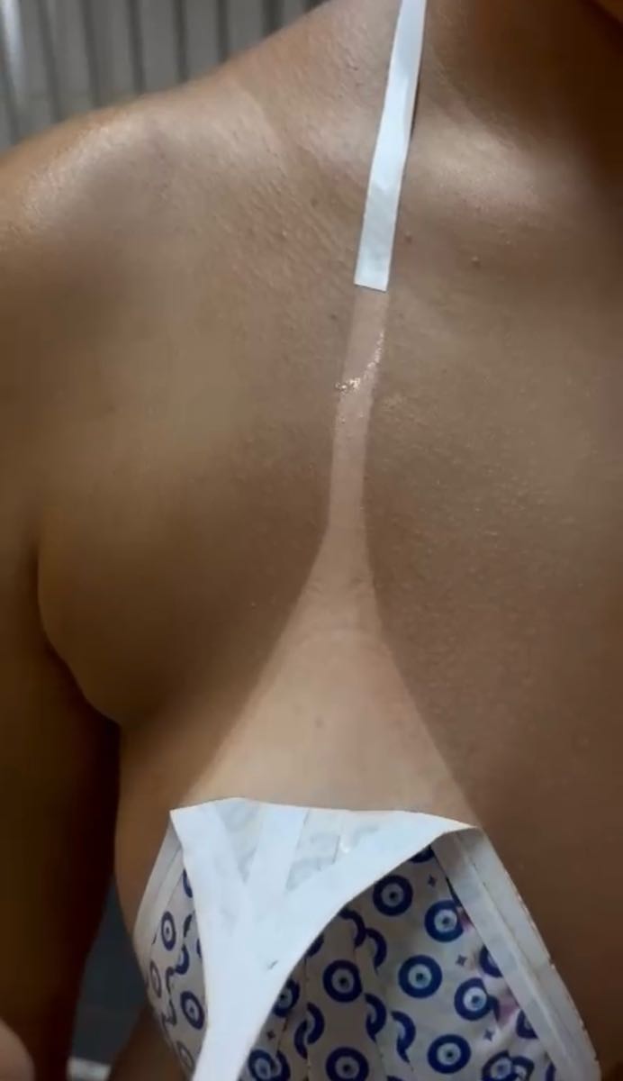Resultado de bronzeamento artificial feito no Espaço Bellesis, com a marca do biquíni