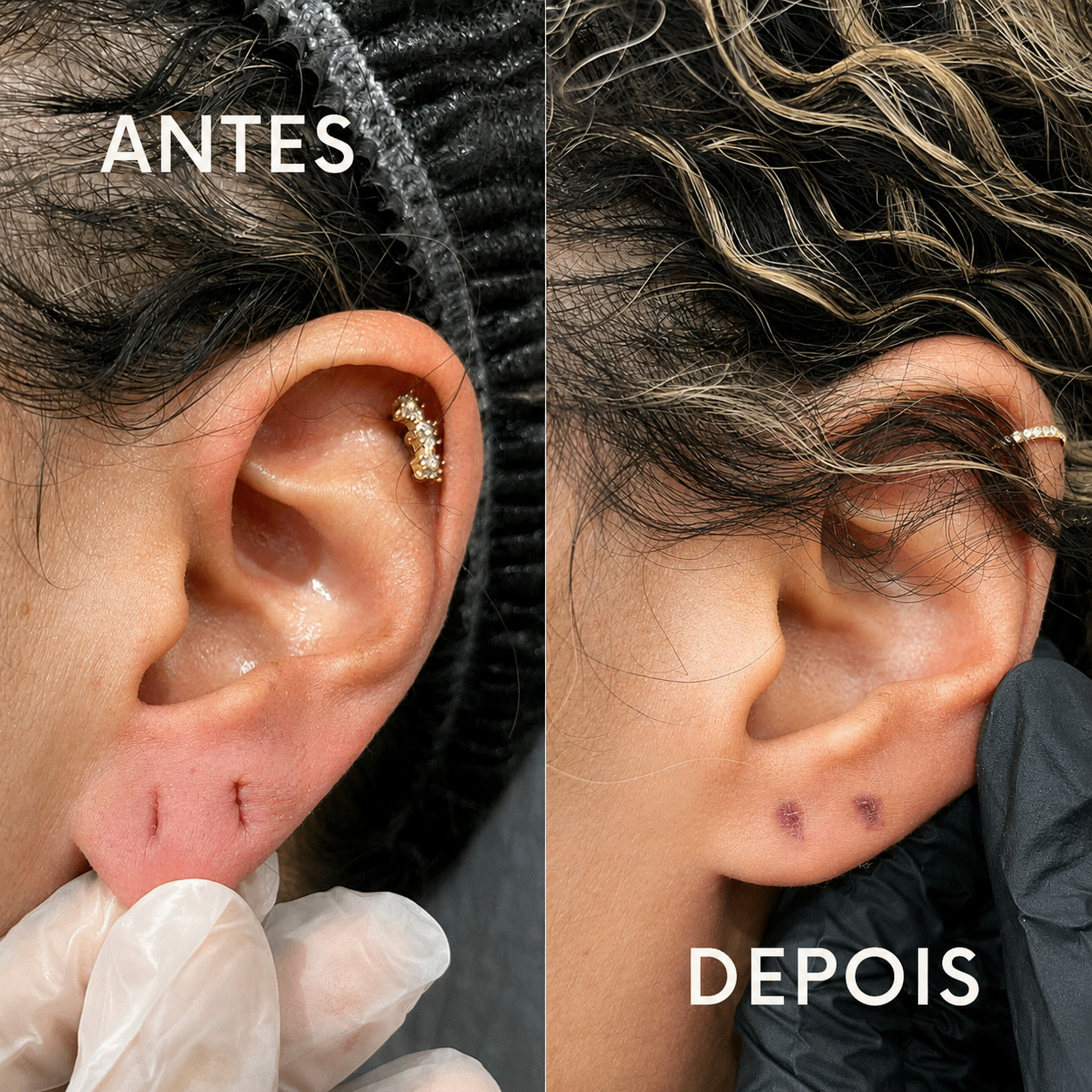 Antes e depois de lobuloplastia não cirúrgica no lóbulo da orelha