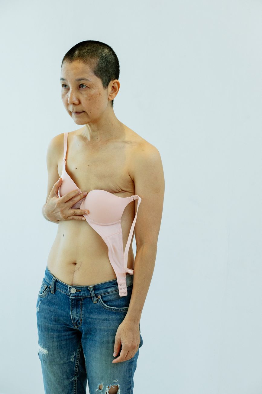 Mulher em sutiã pós-cirúrgico após cirurgia de mama