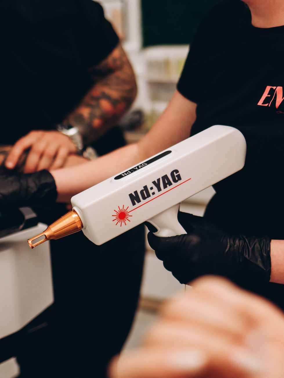 Aparelho de laser Nd:YAG usado em remoção de tatuagem